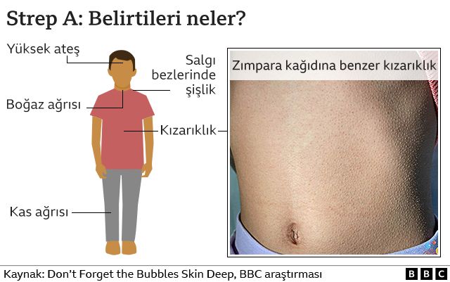 Strep A Belirtileri Nelerdir?
